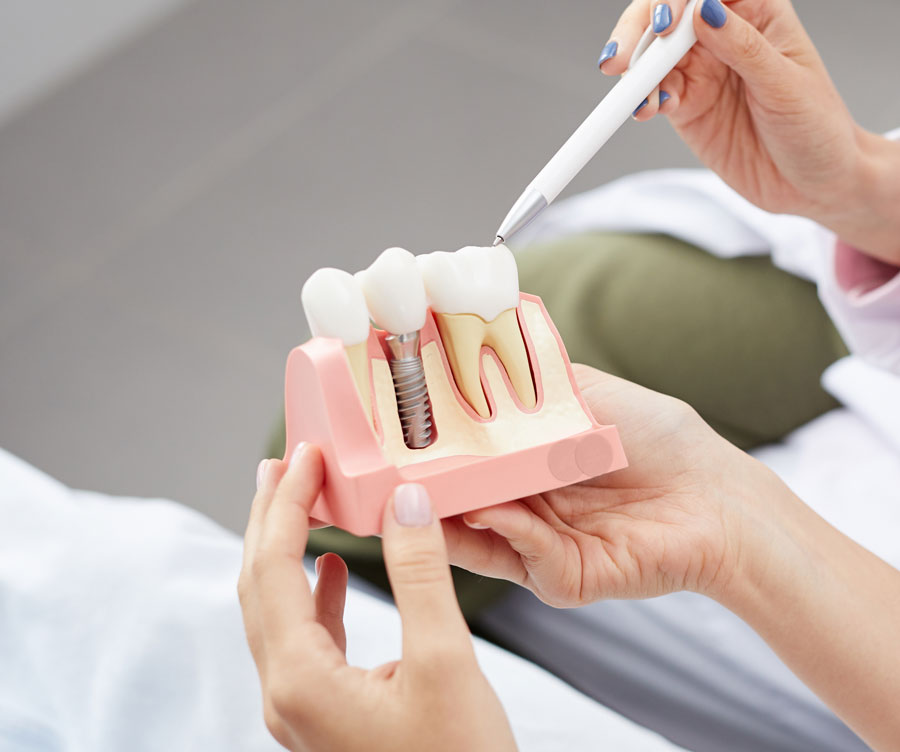 Dentista mostrando modelo de implante dental