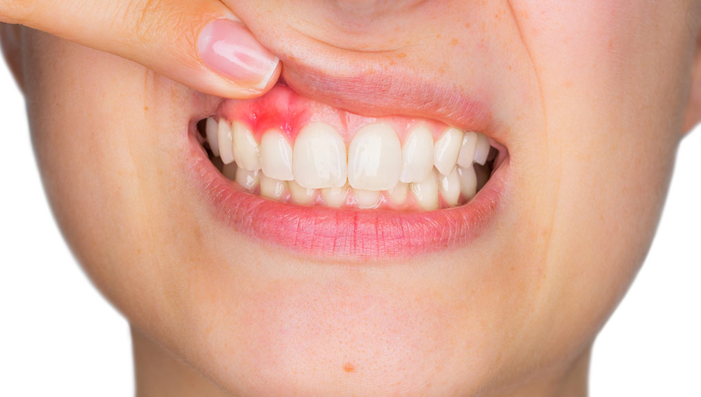 sintomas-enfermedad-periodontal