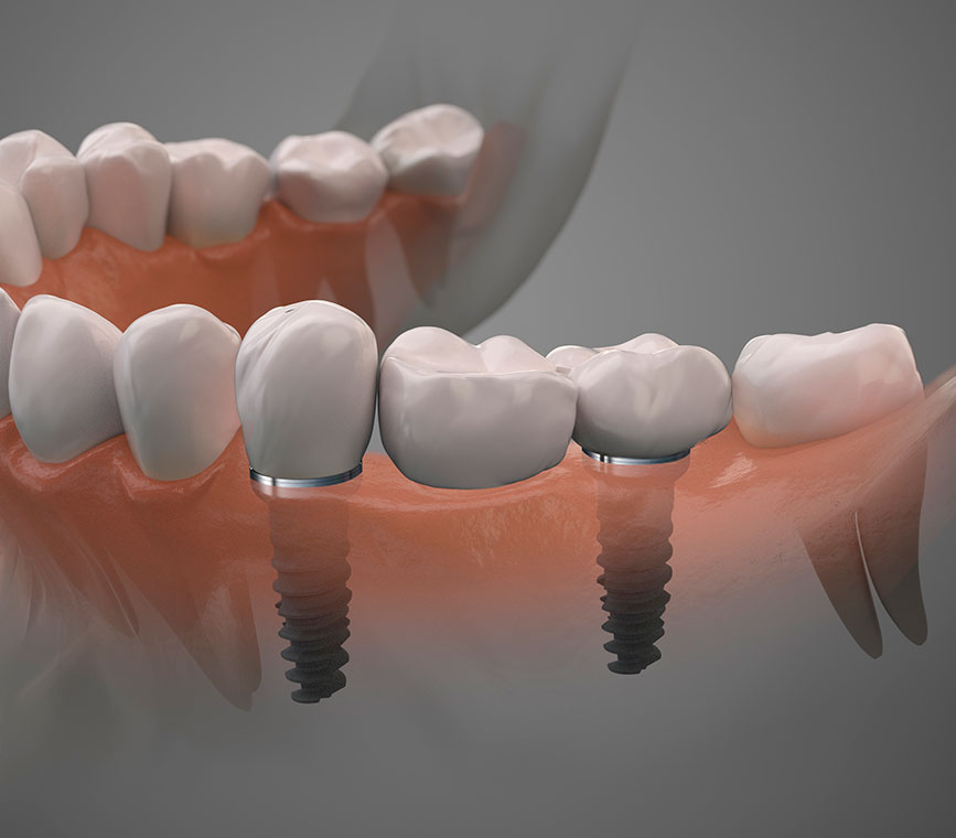 Modelo 3D de implantes dentales