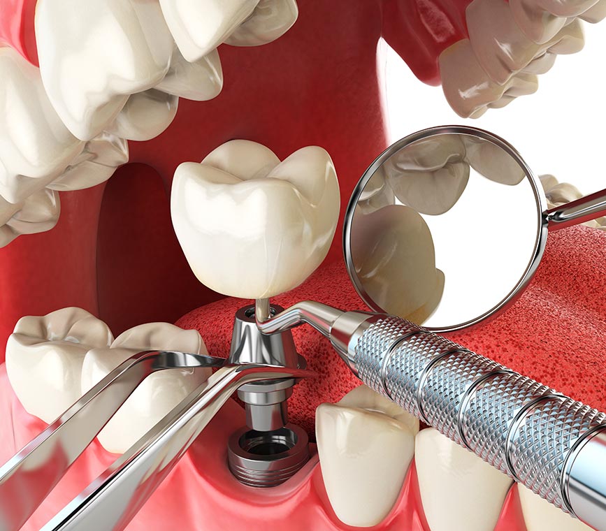 Preguntas frecuentes sobre el tratamiento de implantes dentales
